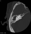 Cholesteatoma (Radiopaedia 5467-7197 Axial bone window 9).jpg