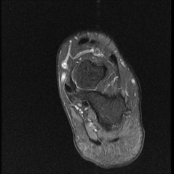 File:Chondroblastoma - midfoot (Radiopaedia 64831-73765 E 4).jpg