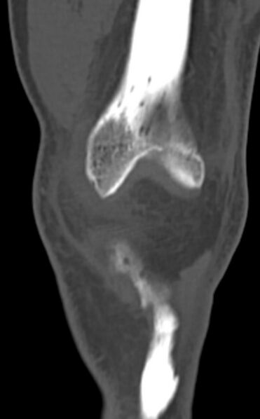 File:Chondrocalcinosis (Radiopaedia 82862-97173 Coronal bone window 22).jpg