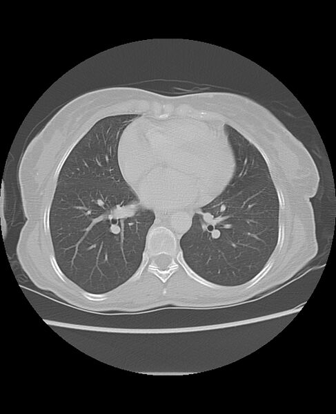 File:Chondrosarcoma (Radiopaedia 79427-92532 Axial lung window 35).jpg
