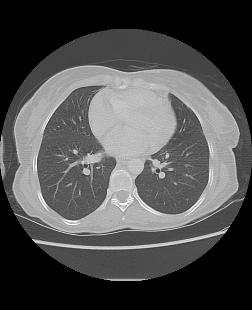 Chondrosarcoma (Radiopaedia 79427-92532 Axial lung window 35).jpg