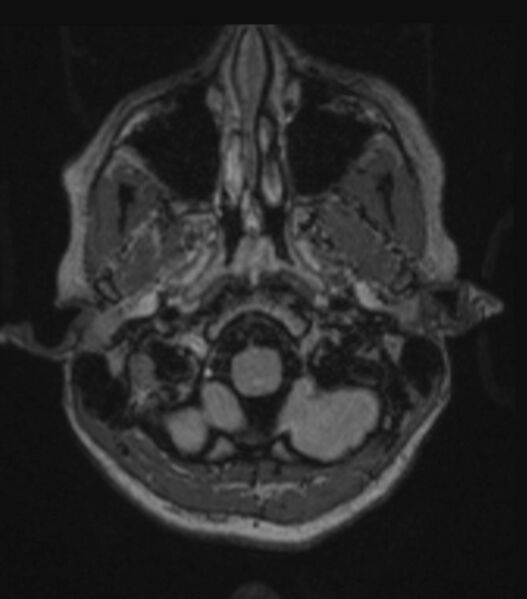 File:Choroid plexus carcinoma (Radiopaedia 91013-108553 Axial FLAIR C+ 79).jpg