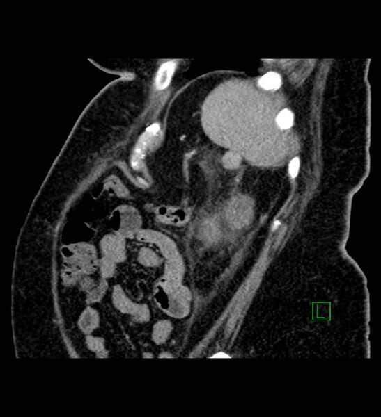 File:Chromophobe renal cell carcinoma (Radiopaedia 84239-99519 D 22).jpg