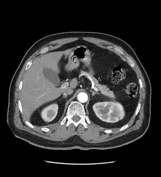 File:Chromophobe renal cell carcinoma (Radiopaedia 86879-103083 B 40).jpg