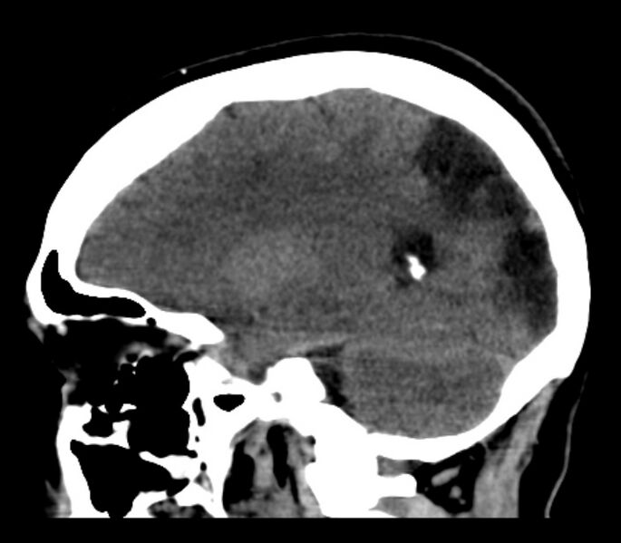 File:Chronic bilateral occipital lobe infarcts (Radiopaedia 31276-31996 C 26).jpg