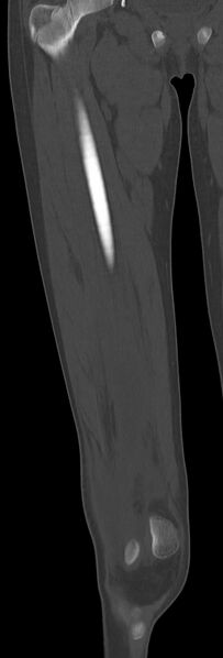 File:Chronic ostemyelitis of the femur with long sinus tract (Radiopaedia 74947-85982 Coronal bone window 32).jpg