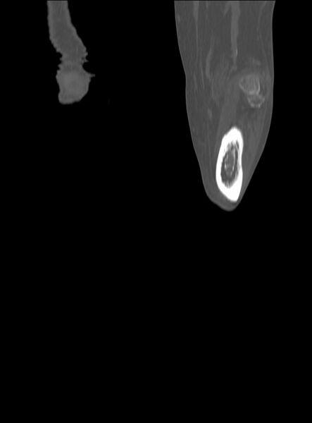 File:Chronic osteomyelitis - tibia (with sequestrum) (Radiopaedia 73273-84090 Coronal non-contrast 55).jpg