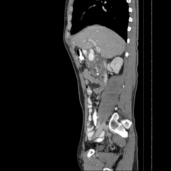 File:Chronic pancreatitis (Radiopaedia 21022-20949 D 13).jpg
