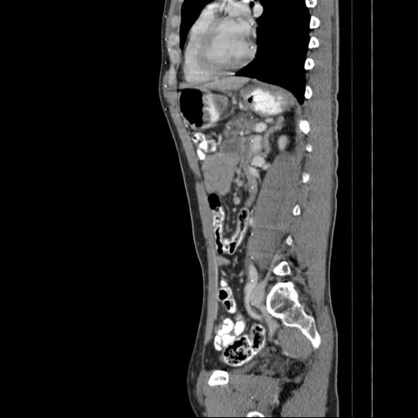 File:Chronic pancreatitis (Radiopaedia 21022-20949 D 8).jpg