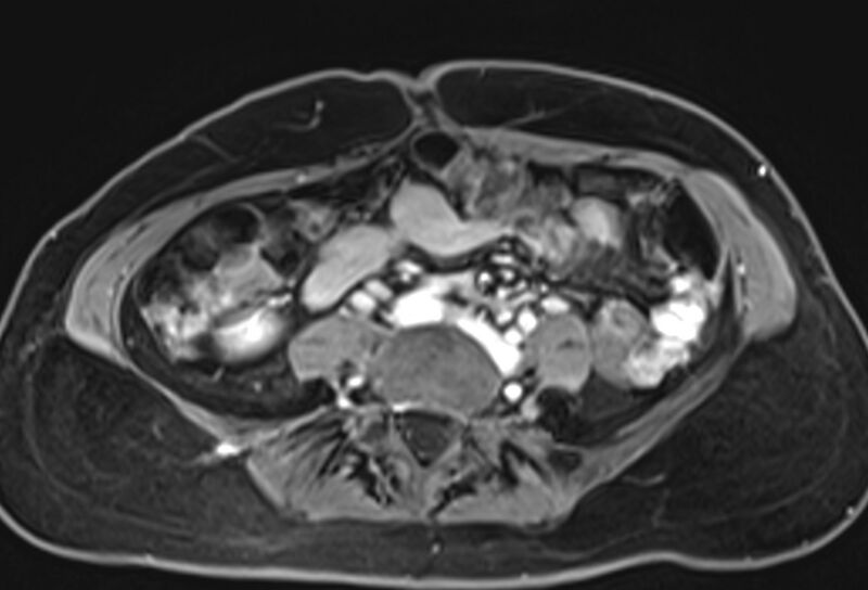File:Chronic pancreatitis - pancreatic duct calculi (Radiopaedia 71818-82250 Axial T1 C+ fat sat 58).jpg