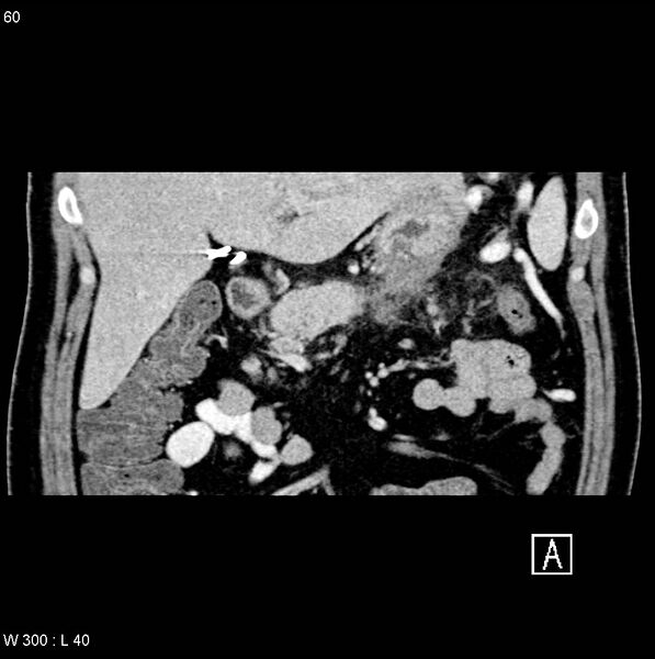 File:Chronic pancreatitis and pseudocysts (Radiopaedia 6724-7935 C 3).jpg
