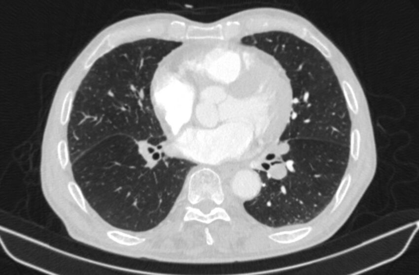 Chronic pulmonary embolism (Radiopaedia 91241-108843 Axial lung window 56).jpg