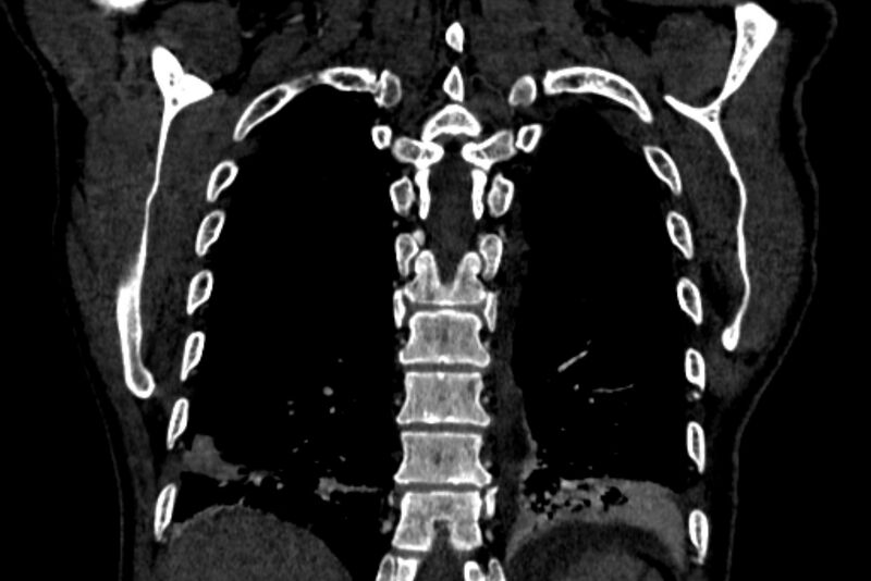 File:Chronic pulmonary embolism with bubbly consolidation (Radiopaedia 91248-108850 B 118).jpg