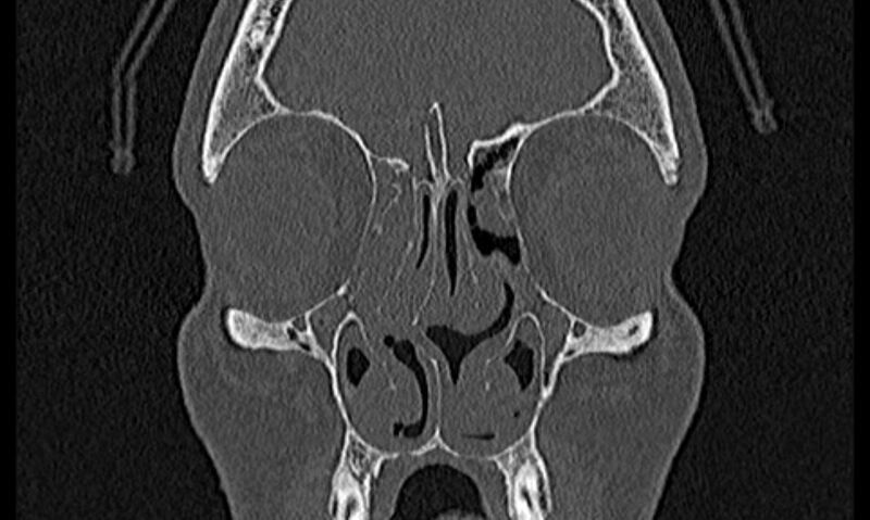 File:Chronic rhinosinusitis (Radiopaedia 65079-74075 Coronal bone window 24).jpg