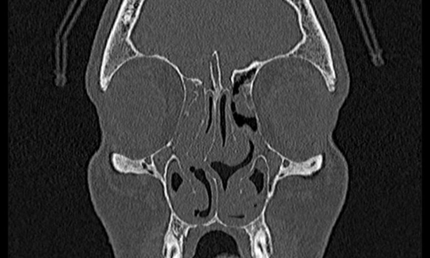 Chronic rhinosinusitis (Radiopaedia 65079-74075 Coronal bone window 24).jpg