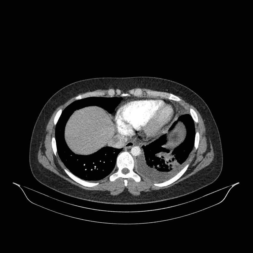 Chronic thromboembolic pulmonary hypertension (CTEPH) (Radiopaedia 74597-85532 Axial C+ CTPA 45).jpg