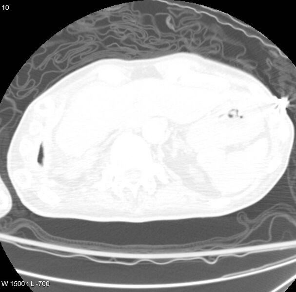 File:Clagett thoracotomy (Radiopaedia 8568-9403 Axial lung window 1).jpg