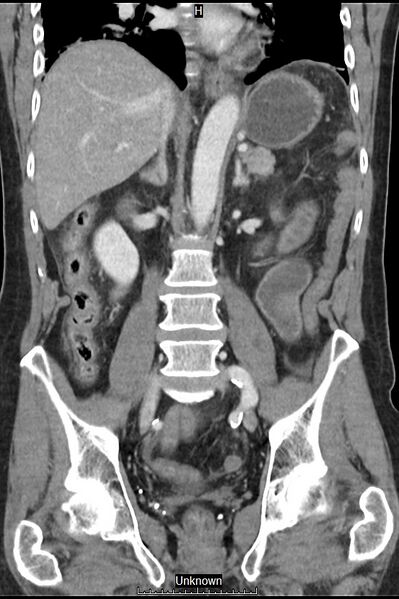 File:Closed loop bowel obstruction and ischemia (Radiopaedia 86959-103180 B 25).jpg