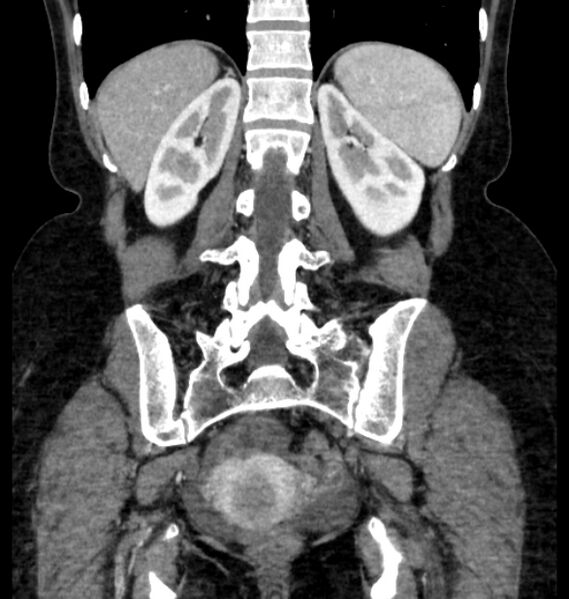 File:Closed loop small bowel obstruction (Radiopaedia 71211-81508 B 96).jpg