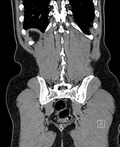 File:Closed loop small bowel obstruction - internal hernia (Radiopaedia 57806-64778 A 101).jpg