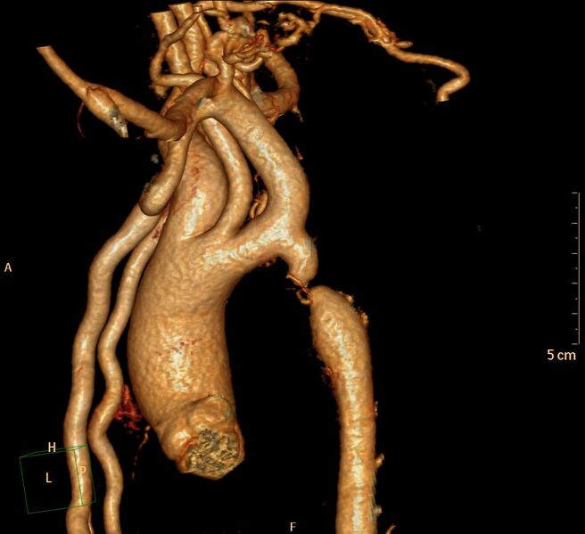 File:Coarctation of the aorta (Radiopaedia 27458-27657 Sagittal 3D 2).jpg