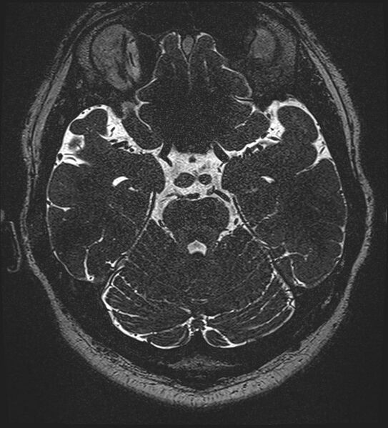 File:Cochlear incomplete partition type III associated with hypothalamic hamartoma (Radiopaedia 88756-105498 Axial T2 126).jpg