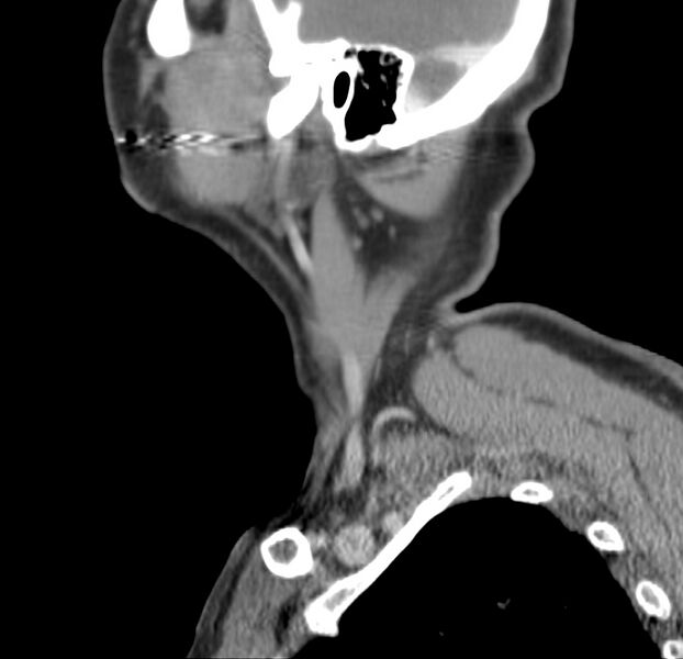 File:Colloid cyst of thyroid (Radiopaedia 22897-22923 Sagittal C+ delayed 49).jpg