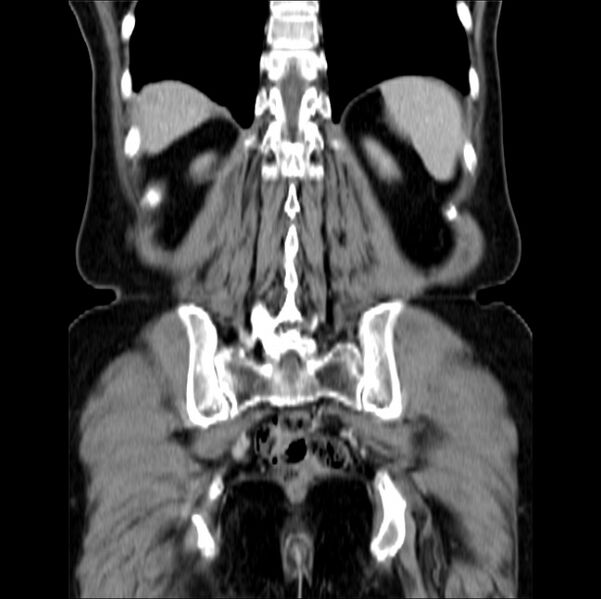 File:Colon carcinoma with hepatic metastases (Radiopaedia 29477-29961 B 35).jpg