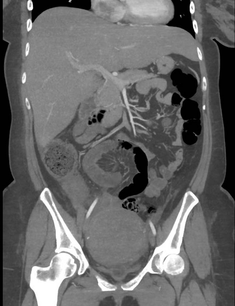 File:Colonic pseudo-obstruction (Radiopaedia 79752-92980 B 32).png