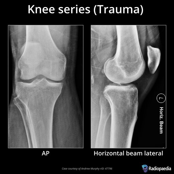 File:Knee series (trauma) (Radiopaedia 68581).jpeg