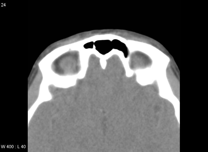 File:Nasolacrimal dacrocystocele (Radiopaedia 13814-13694 Axial liver window 24).jpg