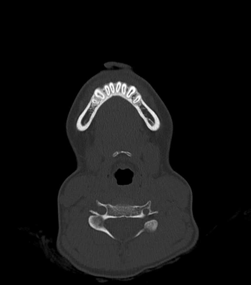 Nasoorbitoethmoid fracture (Radiopaedia 90044-107205 Axial bone window 21).jpg