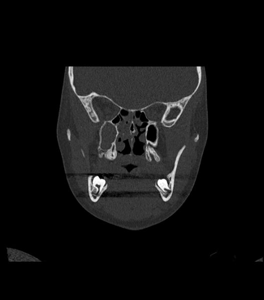 File:Nasoorbitoethmoid fracture (Radiopaedia 90044-107205 Coronal bone window 61).jpg