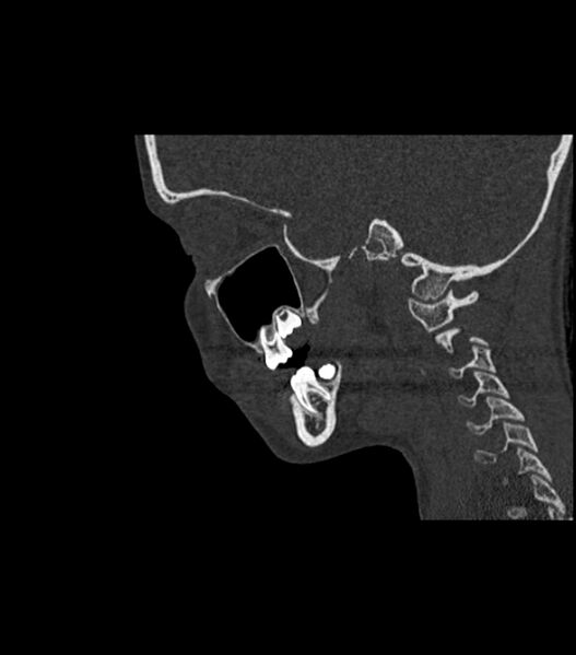File:Nasoorbitoethmoid fracture (Radiopaedia 90044-107205 Sagittal bone window 53).jpg