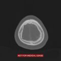 Nasopharyngeal carcinoma recurrence - skull base destruction (Radiopaedia 29107-29490 Axial bone window 10).jpg