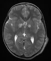 Neurofibromatosis type 1 (Radiopaedia 6954-8063 Axial T2 7).jpg