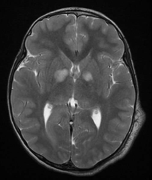 File:Neurofibromatosis type 1 (Radiopaedia 6954-8063 Axial T2 7).jpg