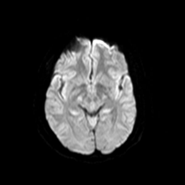 File:Neurofibromatosis type 2 (Radiopaedia 67470-76871 Axial DWI 9).jpg