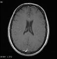 Neurosarcoidosis (Radiopaedia 10930-17204 Axial T1 C+ 12).jpg
