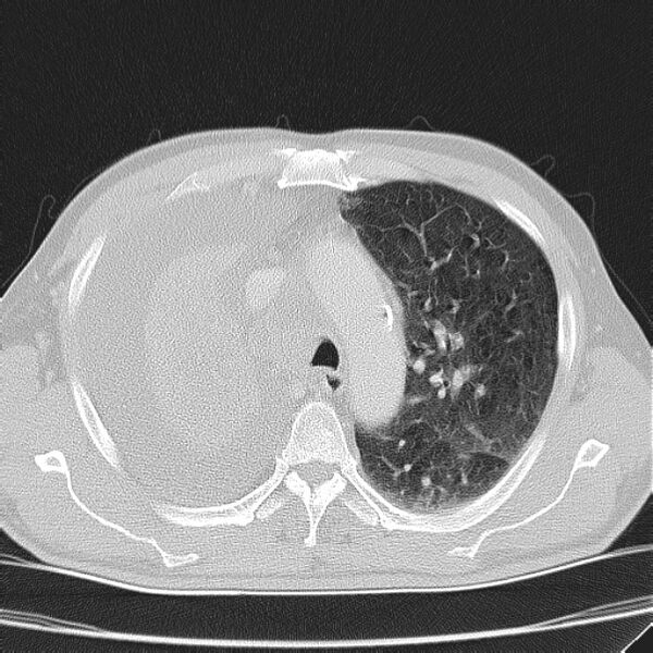 File:Non small-cell lung cancer (Radiopaedia 24467-24769 lung window 15).jpg