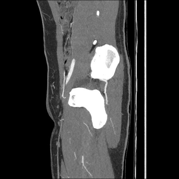 File:Normal CT angiogram of pelvis (Radiopaedia 45390-49430 C 25).jpg