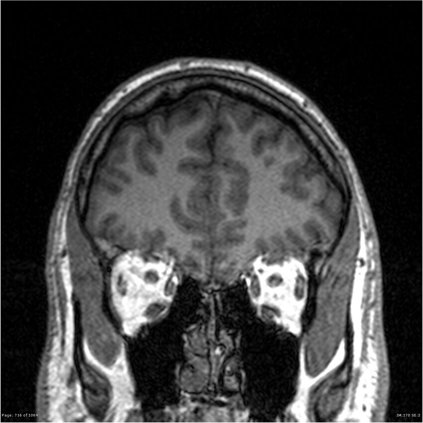 Normal brain MRI (non-focal epilepsy protocol) (Radiopaedia 38571-40700 Coronal T1 84).jpg