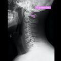 Normal cervical spine radiographs (Radiopaedia 32505-96697 A 4).jpeg