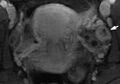 Normal corpus luteum on MRI (Radiopaedia 13818-13696 B 1).jpg