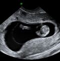 Normal early pregnancy with physiological gut herniation (Radiopaedia 13788).jpg