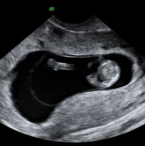Ultrasound: early pregnancy