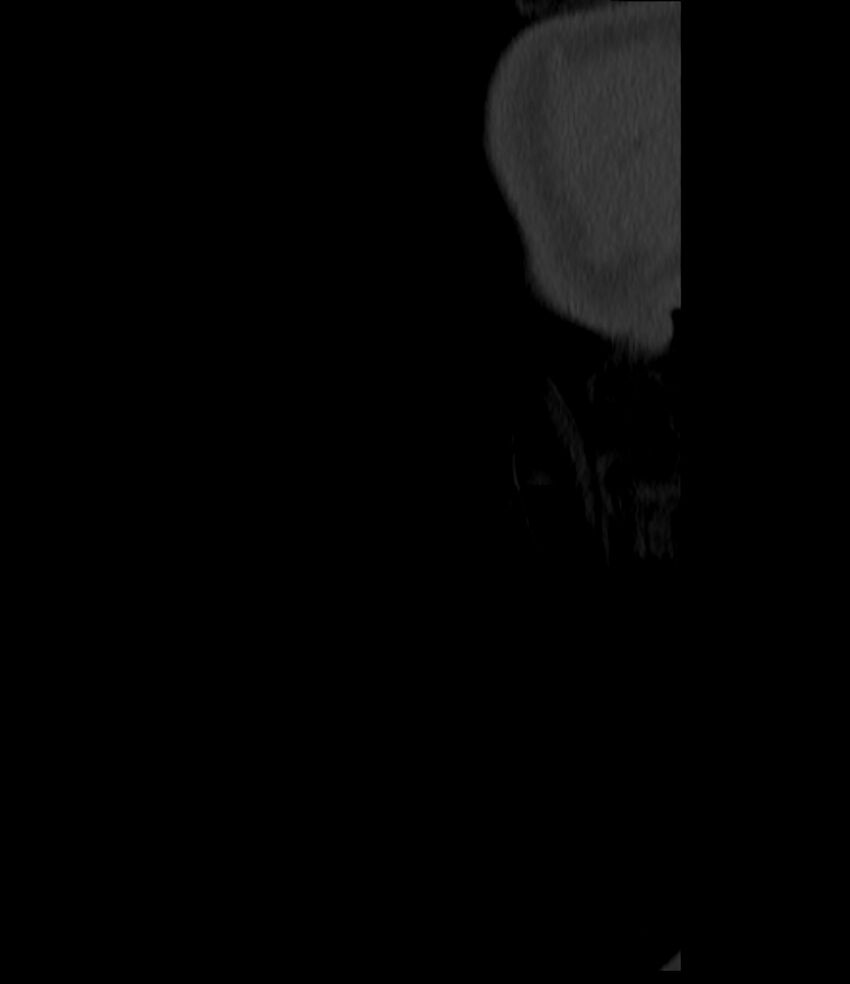 Normal facial bone CT (Radiopaedia 88742-105476 Sagittal bone window 7).jpg