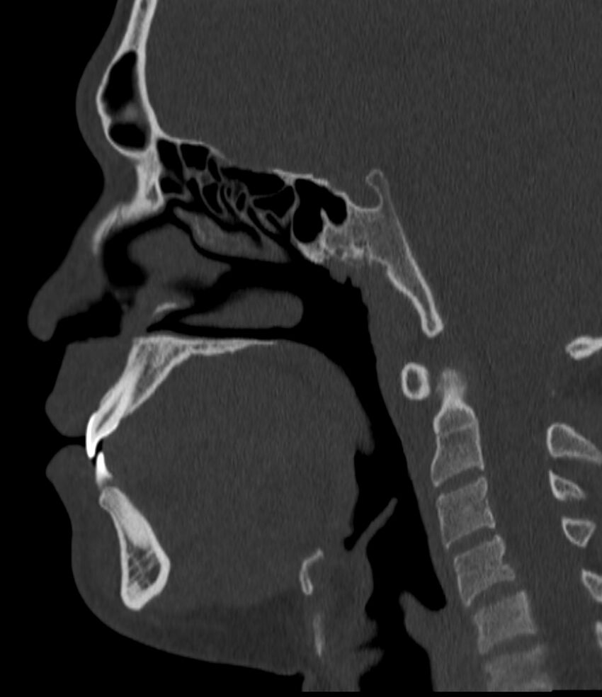 Normal facial bone CT (Radiopaedia 88742-105476 Sagittal bone window 92).jpg