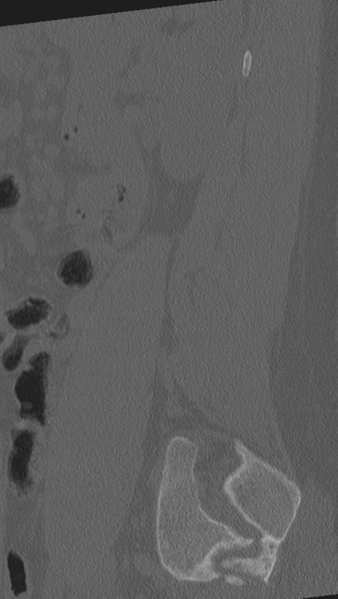 File:Normal lumbar spine CT (Radiopaedia 46533-50986 Sagittal bone window 17).png