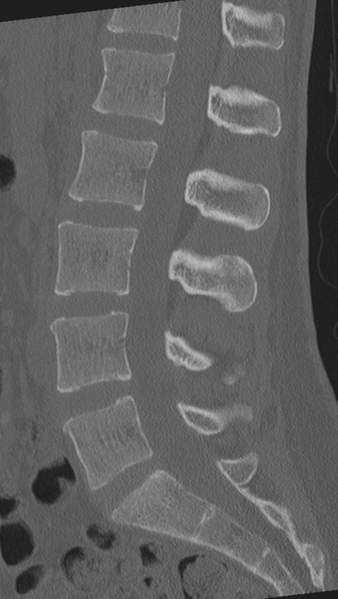 File:Normal lumbar spine CT (Radiopaedia 46533-50986 Sagittal bone window 53).png